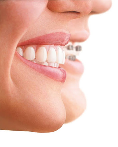 Invisalign | Clínica Max Dental Móstoles | Implantes | Blanqueamiento Dental